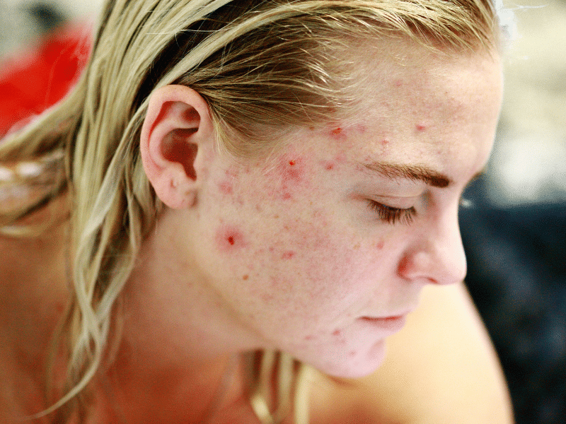 Best Acne Treatments for Every Skin Type 2022